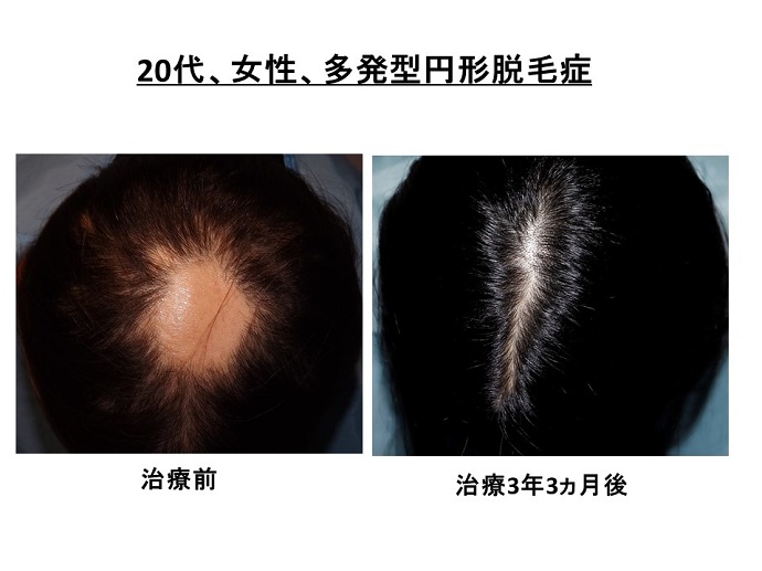 円形脱毛症　病院